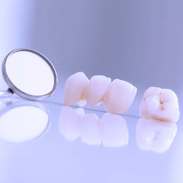 Dental Bridges Belleview, Fl Ocala Dental Care Over 30